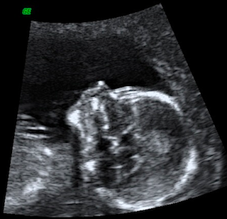 ultrasound